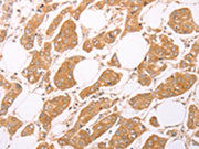 The image on the left is immunohistochemistry of paraffin-embedded Human breast cancer tissue using CSB-PA145488(LEPR Antibody) at dilution 1/25, on the right is treated with synthetic peptide. (Original magnification: ×200)