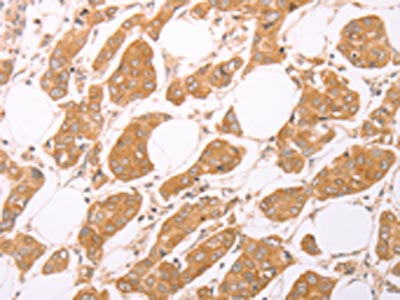 The image on the left is immunohistochemistry of paraffin-embedded Human breast cancer tissue using CSB-PA145488(LEPR Antibody) at dilution 1/25, on the right is treated with synthetic peptide. (Original magnification: ×200)