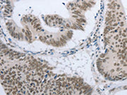 The image on the left is immunohistochemistry of paraffin-embedded Human colon cancer tissue using CSB-PA145524(AKAP8 Antibody) at dilution 1/15, on the right is treated with synthetic peptide. (Original magnification: ×200)