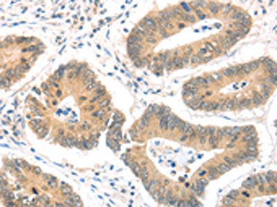 The image on the left is immunohistochemistry of paraffin-embedded Human colon cancer tissue using CSB-PA145666(MAGED1 Antibody) at dilution 1/30, on the right is treated with fusion protein. (Original magnification: ×200)