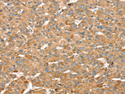 The image on the left is immunohistochemistry of paraffin-embedded Human liver cancer tissue using CSB-PA146109(MORF4L1 Antibody) at dilution 1/35, on the right is treated with synthetic peptide. (Original magnification: ×200)