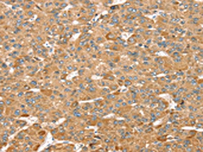 The image on the left is immunohistochemistry of paraffin-embedded Human liver cancer tissue using CSB-PA146109(MORF4L1 Antibody) at dilution 1/35, on the right is treated with synthetic peptide. (Original magnification: ×200)