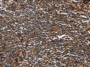 The image on the left is immunohistochemistry of paraffin-embedded Human tonsil tissue using CSB-PA146268(MAGEA3 Antibody) at dilution 1/50, on the right is treated with synthetic peptide. (Original magnification: ×200)