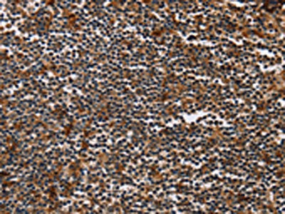 The image on the left is immunohistochemistry of paraffin-embedded Human tonsil tissue using CSB-PA146268(MAGEA3 Antibody) at dilution 1/50, on the right is treated with synthetic peptide. (Original magnification: ×200)