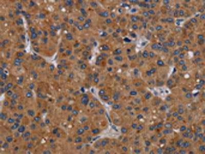 The image on the left is immunohistochemistry of paraffin-embedded Human liver cancer tissue using CSB-PA146607(PDGFC Antibody) at dilution 1/40, on the right is treated with synthetic peptide. (Original magnification: ×200)