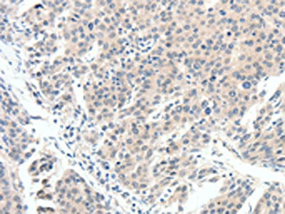 The image on the left is immunohistochemistry of paraffin-embedded Human breast cancer tissue using CSB-PA146616(SCN10A Antibody) at dilution 1/20, on the right is treated with synthetic peptide. (Original magnification: ×200)