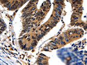 The image on the left is immunohistochemistry of paraffin-embedded Human colon cancer tissue using CSB-PA146631(NEFL Antibody) at dilution 1/20, on the right is treated with fusion protein. (Original magnification: ×200)
