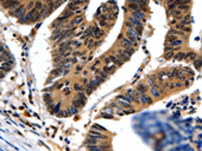 The image on the left is immunohistochemistry of paraffin-embedded Human colon cancer tissue using CSB-PA146631(NEFL Antibody) at dilution 1/20, on the right is treated with fusion protein. (Original magnification: ×200)