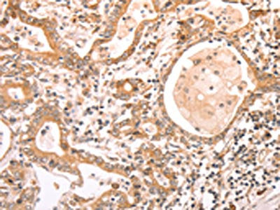 The image on the left is immunohistochemistry of paraffin-embedded Human gastic cancer tissue using CSB-PA146685(ABCF1 Antibody) at dilution 1/40, on the right is treated with fusion protein. (Original magnification: ×200)