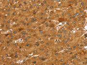 The image on the left is immunohistochemistry of paraffin-embedded Human liver cancer tissue using CSB-PA146812(SLC7A9 Antibody) at dilution 1/35, on the right is treated with synthetic peptide. (Original magnification: ×200)