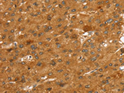 The image on the left is immunohistochemistry of paraffin-embedded Human liver cancer tissue using CSB-PA146812(SLC7A9 Antibody) at dilution 1/35, on the right is treated with synthetic peptide. (Original magnification: ×200)