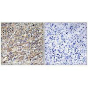 Immunohistochemistry analysis of paraffin-embedded human liver carcinoma tissue using COX17 antibody.