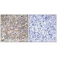 Immunohistochemistry analysis of paraffin-embedded human liver carcinoma tissue using COX17 antibody.