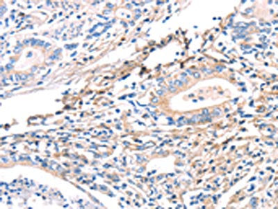 The image on the left is immunohistochemistry of paraffin-embedded Human gastric cancer tissue using CSB-PA146937(TWF2 Antibody) at dilution 1/40, on the right is treated with fusion protein. (Original magnification: ×200)