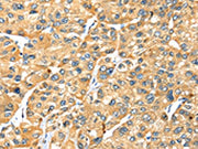 The image on the left is immunohistochemistry of paraffin-embedded Human liver cancer tissue using CSB-PA147046(STX7 Antibody) at dilution 1/25, on the right is treated with fusion protein. (Original magnification: ×200)