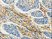 The image on the left is immunohistochemistry of paraffin-embedded Human lung cancer tissue using CSB-PA147089(CAP1 Antibody) at dilution 1/25, on the right is treated with fusion protein. (Original magnification: ×200)