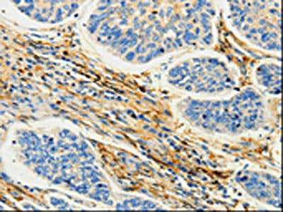 The image on the left is immunohistochemistry of paraffin-embedded Human lung cancer tissue using CSB-PA147089(CAP1 Antibody) at dilution 1/25, on the right is treated with fusion protein. (Original magnification: ×200)