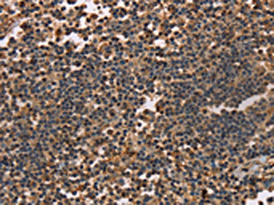 The image on the left is immunohistochemistry of paraffin-embedded Human tonsil tissue using CSB-PA147162(KLK14 Antibody) at dilution 1/40, on the right is treated with synthetic peptide. (Original magnification: ×200)