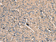 The image on the left is immunohistochemistry of paraffin-embedded Human liver cancer tissue using CSB-PA147244(SCN1B Antibody) at dilution 1/35, on the right is treated with synthetic peptide. (Original magnification: ×200)