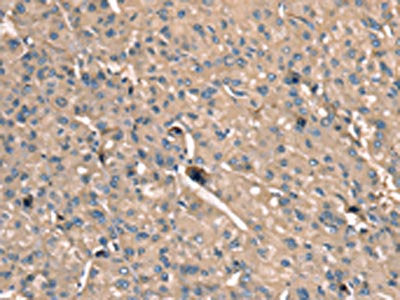 The image on the left is immunohistochemistry of paraffin-embedded Human liver cancer tissue using CSB-PA147244(SCN1B Antibody) at dilution 1/35, on the right is treated with synthetic peptide. (Original magnification: ×200)
