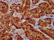 IHC image of CSB-PA14729A0Rb diluted at 1:200 and staining in paraffin-embedded human liver cancer performed on a Leica BondTM system. After dewaxing and hydration, antigen retrieval was mediated by high pressure in a citrate buffer (pH 6.0). Sect...