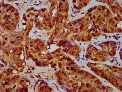 IHC image of CSB-PA14729A0Rb diluted at 1:200 and staining in paraffin-embedded human liver cancer performed on a Leica BondTM system. After dewaxing and hydration, antigen retrieval was mediated by high pressure in a citrate buffer (pH 6.0). Sect...