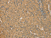 The image on the left is immunohistochemistry of paraffin-embedded Human liver cancer tissue using CSB-PA147463(MORF4L1 Antibody) at dilution 1/35, on the right is treated with synthetic peptide. (Original magnification: ×200)