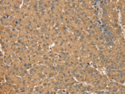 The image on the left is immunohistochemistry of paraffin-embedded Human liver cancer tissue using CSB-PA147463(MORF4L1 Antibody) at dilution 1/35, on the right is treated with synthetic peptide. (Original magnification: ×200)
