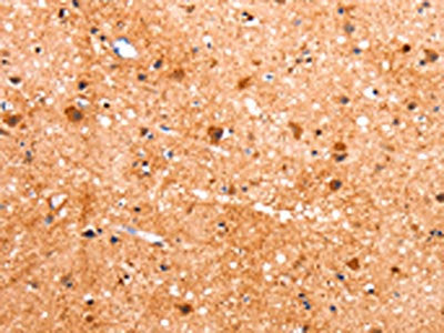 The image on the left is immunohistochemistry of paraffin-embedded Human brain tissue using CSB-PA147566(FABP7 Antibody) at dilution 1/22, on the right is treated with fusion protein. (Original magnification: ×200)