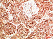 Immunohistochemical analysis of paraffin-embedded Human Lung Carcinoma Tissue using FAK Rabbit pAb diluted at 1:500