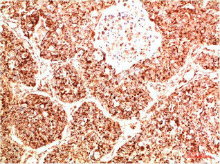 Immunohistochemical analysis of paraffin-embedded Human Lung Carcinoma Tissue using FAK Rabbit pAb diluted at 1:500