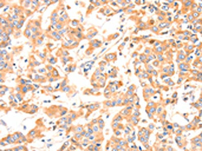 The image on the left is immunohistochemistry of paraffin-embedded Human breast cancer tissue using CSB-PA147820(F13A1 Antibody) at dilution 1/80, on the right is treated with synthetic peptide. (Original magnification: ×200)
