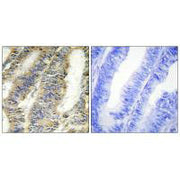 Immunohistochemistry analysis of paraffin-embedded human colon carcinoma tissue, using TNFA antibody.