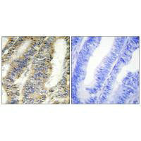 Immunohistochemistry analysis of paraffin-embedded human colon carcinoma tissue, using TNFA antibody.