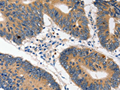 The image on the left is immunohistochemistry of paraffin-embedded Human colon cancer tissue using CSB-PA147894(HDC Antibody) at dilution 1/10, on the right is treated with fusion protein. (Original magnification: ×200)
