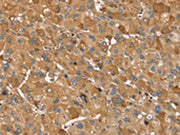 The image on the left is immunohistochemistry of paraffin-embedded Human liver cancer tissue using CSB-PA147931(TRIM34 Antibody) at dilution 1/30, on the right is treated with synthetic peptide. (Original magnification: ×200)