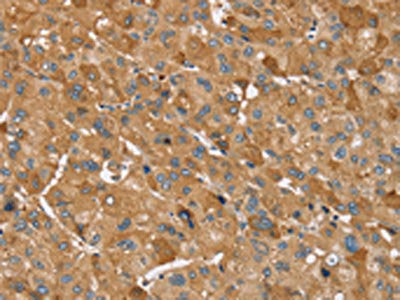 The image on the left is immunohistochemistry of paraffin-embedded Human liver cancer tissue using CSB-PA147931(TRIM34 Antibody) at dilution 1/30, on the right is treated with synthetic peptide. (Original magnification: ×200)
