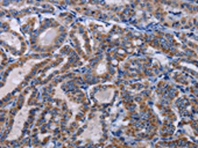 The image on the left is immunohistochemistry of paraffin-embedded Human thyroid cancer tissue using CSB-PA147947(GNAS Antibody) at dilution 1/20, on the right is treated with fusion protein. (Original magnification: ×200)