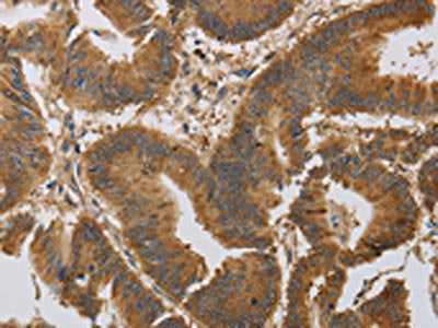 The image on the left is immunohistochemistry of paraffin-embedded Human colon cancer tissue using CSB-PA147999(KCNMB4 Antibody) at dilution 1/30, on the right is treated with synthetic peptide. (Original magnification: ×200)
