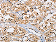 The image on the left is immunohistochemistry of paraffin-embedded Human thyroid cancer tissue using CSB-PA148420(CARD8 Antibody) at dilution 1/40, on the right is treated with fusion protein. (Original magnification: ×200)