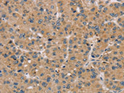The image on the left is immunohistochemistry of paraffin-embedded Human liver cancer tissue using CSB-PA148428(PARP3 Antibody) at dilution 1/25, on the right is treated with fusion protein. (Original magnification: ×200)