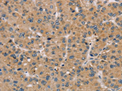 The image on the left is immunohistochemistry of paraffin-embedded Human liver cancer tissue using CSB-PA148428(PARP3 Antibody) at dilution 1/25, on the right is treated with fusion protein. (Original magnification: ×200)