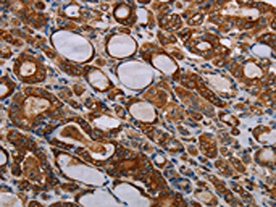 The image on the left is immunohistochemistry of paraffin-embedded Human thyroid cancer tissue using CSB-PA148821(FABP3 Antibody) at dilution 1/40, on the right is treated with synthetic peptide. (Original magnification: ×200)