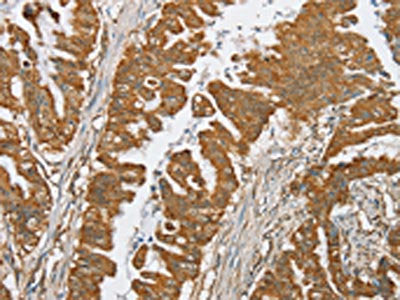 The image on the left is immunohistochemistry of paraffin-embedded Human esophagus cancer tissue using CSB-PA148897(SERINC2 Antibody) at dilution 1/20, on the right is treated with synthetic peptide. (Original magnification: ×200)