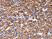 The image on the left is immunohistochemistry of paraffin-embedded Human thyroid cancer tissue using CSB-PA148952(SELPLG Antibody) at dilution 1/50, on the right is treated with fusion protein. (Original magnification: ×200)
