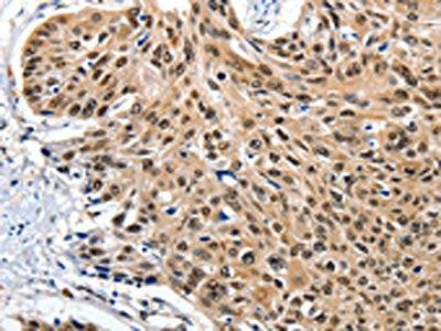 The image on the left is immunohistochemistry of paraffin-embedded Human esophagus cancer tissue using CSB-PA148981(ITGAM Antibody) at dilution 1/20, on the right is treated with synthetic peptide. (Original magnification: ×200)