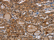 The image on the left is immunohistochemistry of paraffin-embedded Human thyroid cancer tissue using CSB-PA149107(MT-ND1 Antibody) at dilution 1/50, on the right is treated with synthetic peptide. (Original magnification: ×200)