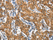The image on the left is immunohistochemistry of paraffin-embedded Human gastic cancer tissue using CSB-PA149151(STAT2 Antibody) at dilution 1/60, on the right is treated with synthetic peptide. (Original magnification: ×200)