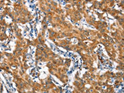 The image on the left is immunohistochemistry of paraffin-embedded Human gastic cancer tissue using CSB-PA149151(STAT2 Antibody) at dilution 1/60, on the right is treated with synthetic peptide. (Original magnification: ×200)
