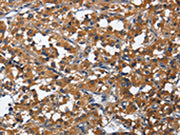 The image on the left is immunohistochemistry of paraffin-embedded Human thyroid cancer tissue using CSB-PA149291(CD27 Antibody) at dilution 1/60, on the right is treated with fusion protein. (Original magnification: ×200)
